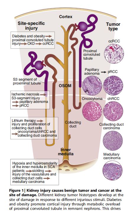 | Kidney injury causes benign tumor and cancer at the site of damage. | Kidney injury causes benign tumor and cancer at the site of damage.