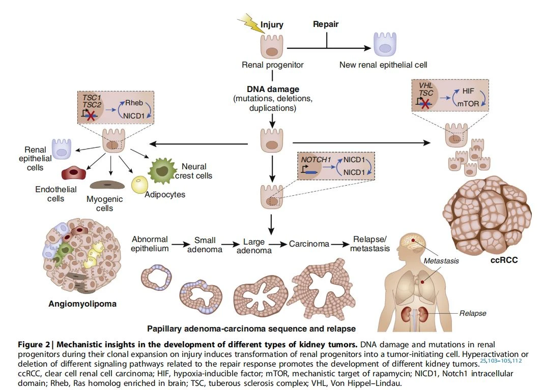 Mechanistic insights in the development of different types of kidney tumors. Mechanistic insights in the development of different types of kidney tumors.