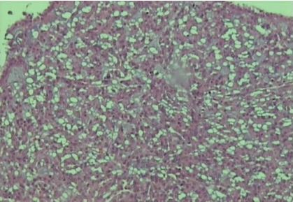 Mucinous Tubular and Spindle Cell Carcinoma of the Kidney