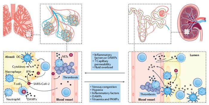 Fig. 1 | Shared pathophysiology between lung and kidney injury in CoVID-19. Fig. 1 | Shared pathophysiology between lung and kidney injury in CoVID-19.