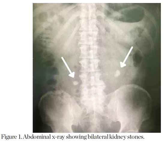 Abdominal x-ray showing bilateral kidney stones. Abdominal x-ray showing bilateral kidney stones.