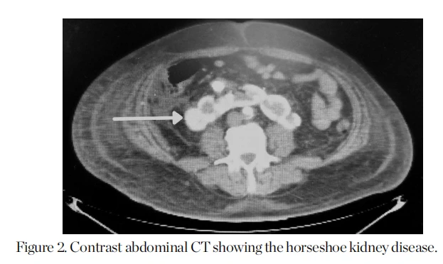 Contrast abdominal CT showing the horseshoe kidney disease. Contrast abdominal CT showing the horseshoe kidney disease.